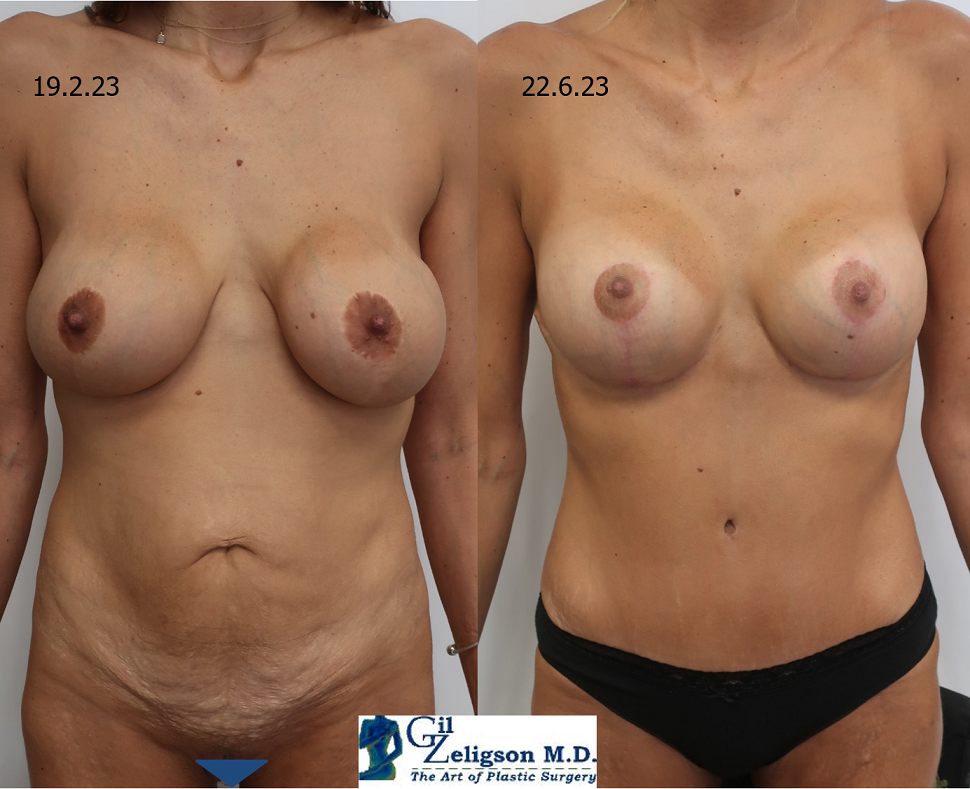 Dr. Gil Zeligson - Mastopexy + Augmentation