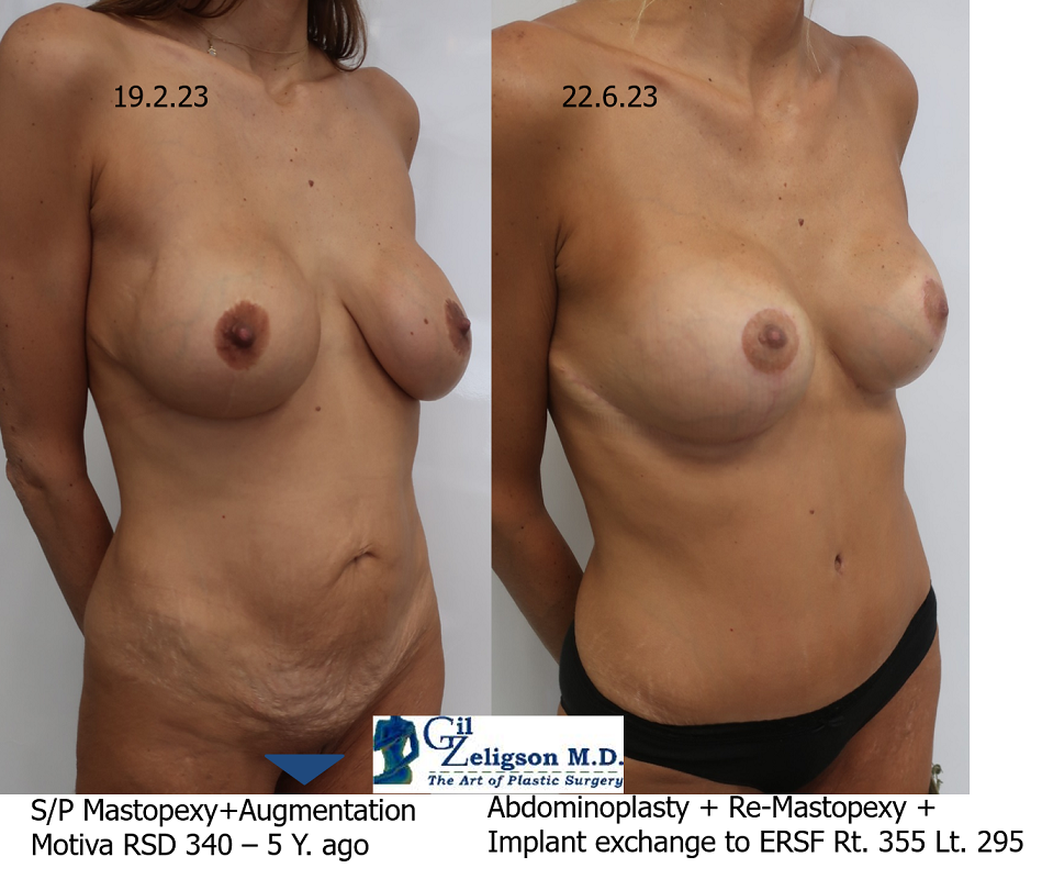 Dr. Gil Zeligson - Mastopexy + Augmentation