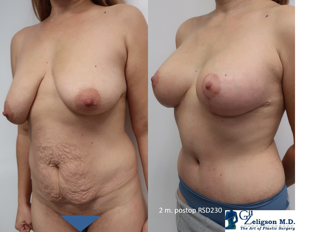 Dr. Gil Zeligson - Mastopexy + Augmentation