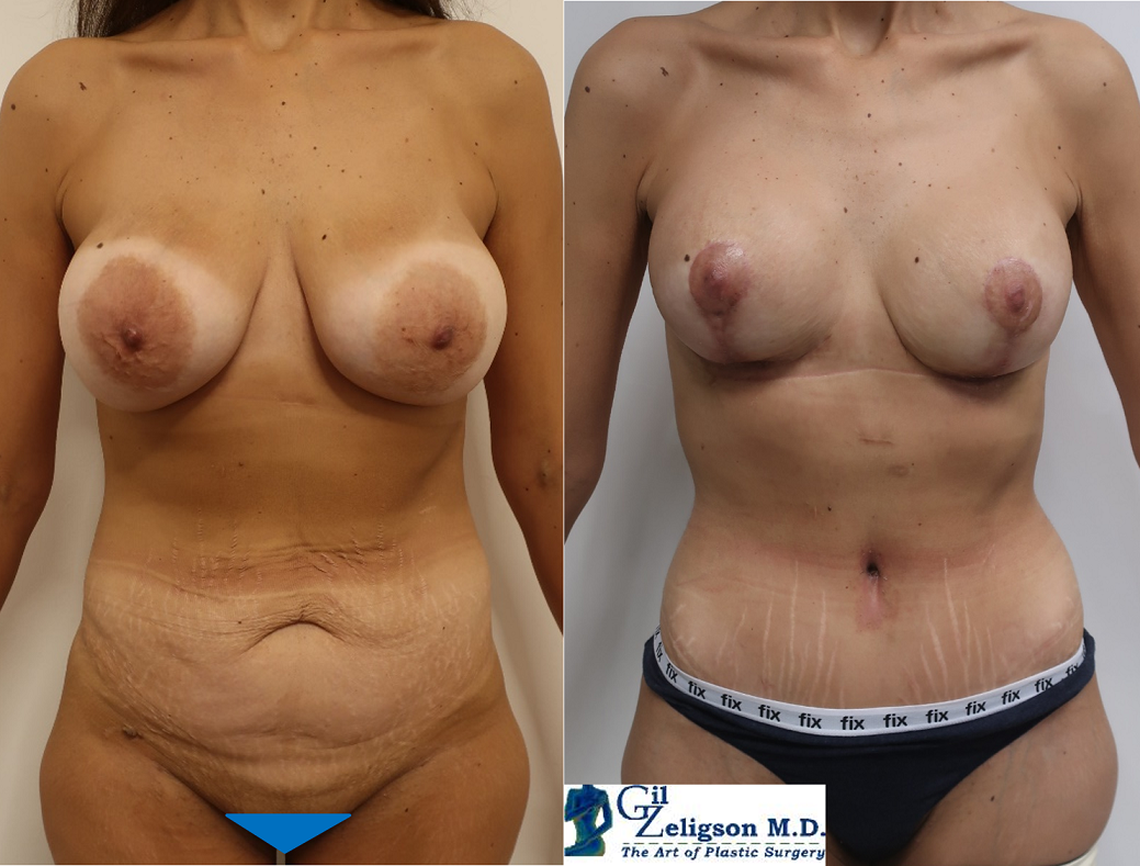 Dr. Gil Zeligson - Mastopexy + Augmentation