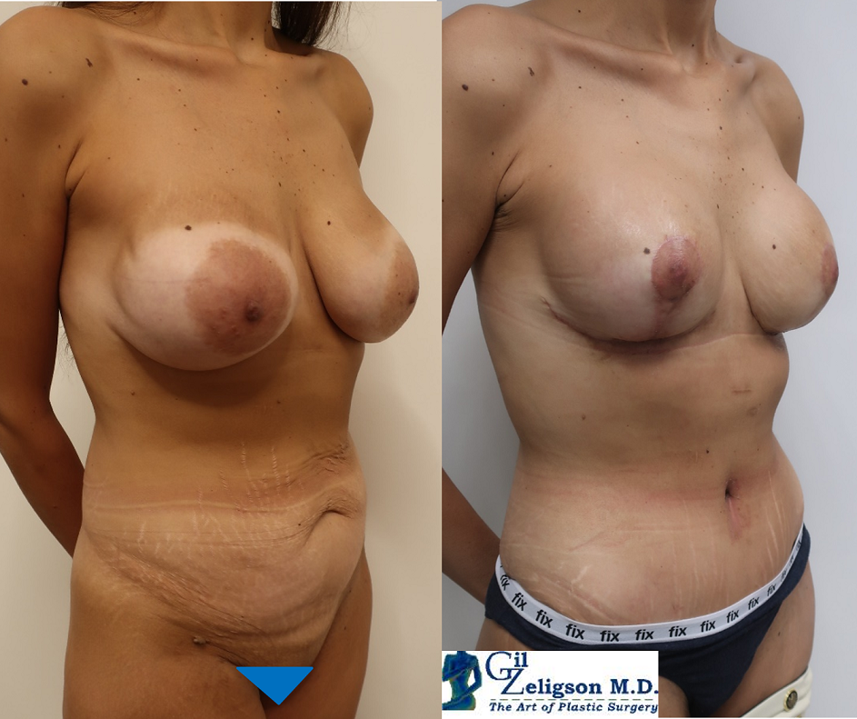 Dr. Gil Zeligson - Mastopexy + Augmentation