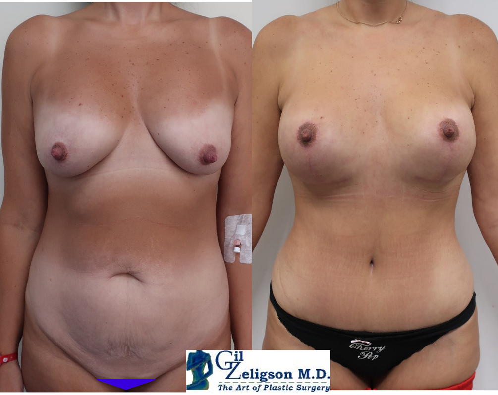 Dr. Gil Zeligson - Mastopexy + Augmentation