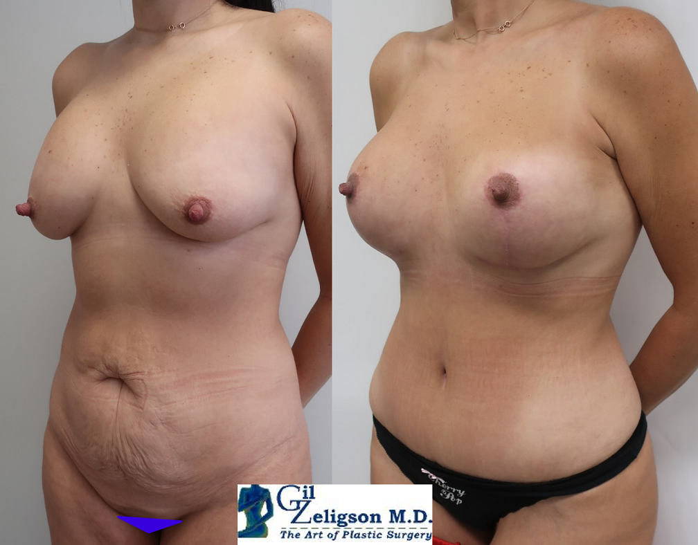 Dr. Gil Zeligson - Mastopexy + Augmentation