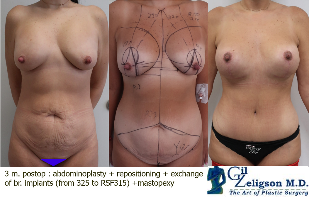 Dr. Gil Zeligson - Mastopexy + Augmentation