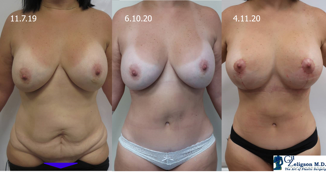 Dr. Gil Zeligson - Mastopexy + Augmentation