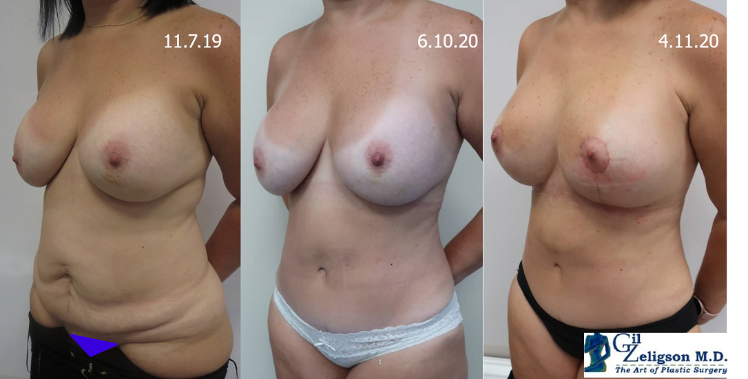 Dr. Gil Zeligson - Mastopexy + Augmentation