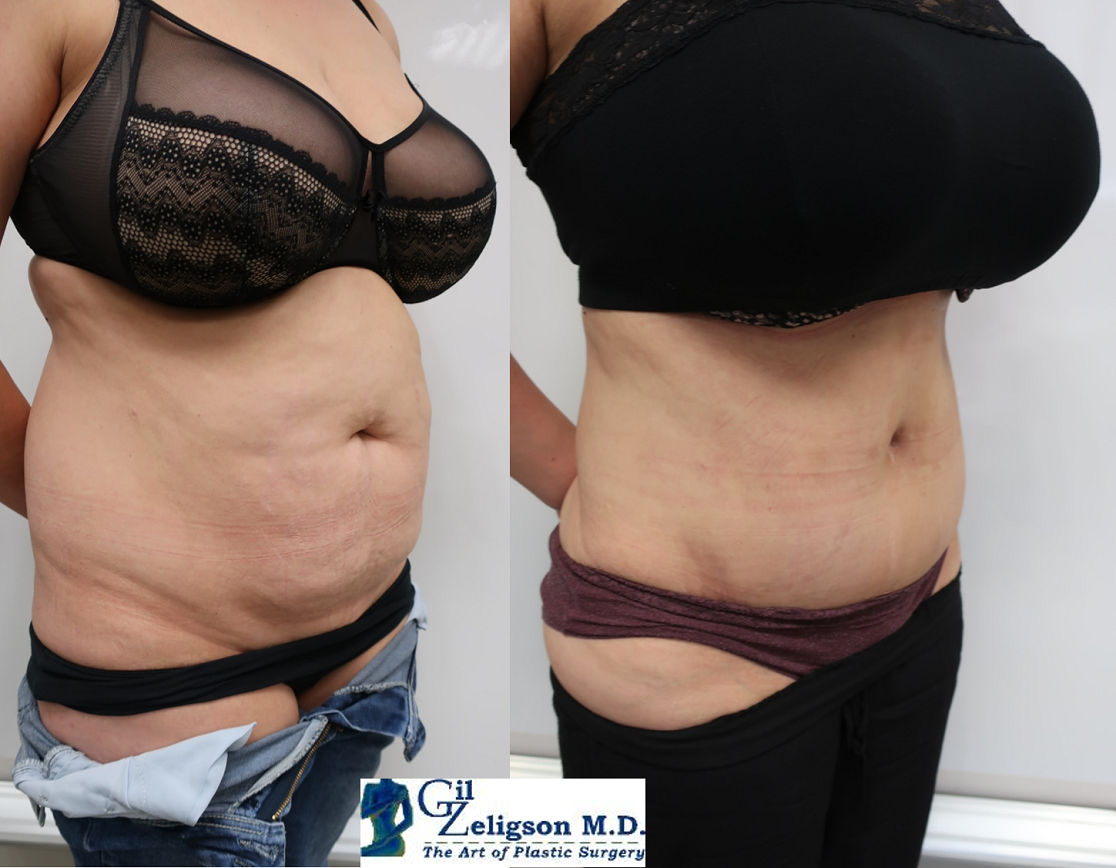 abdominoplasty & liposuction - Dr. Gil