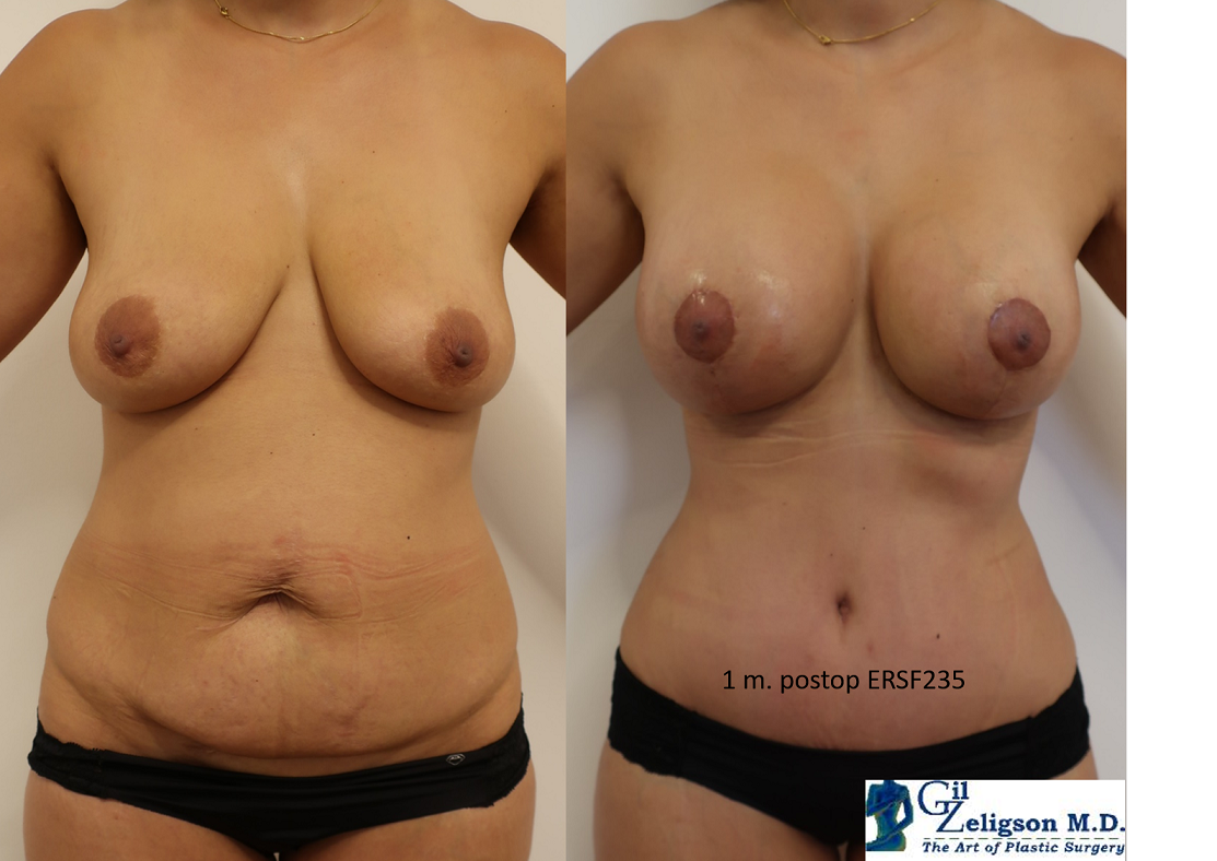 Dr. Gil Zeligson - Mastopexy + Augmentation