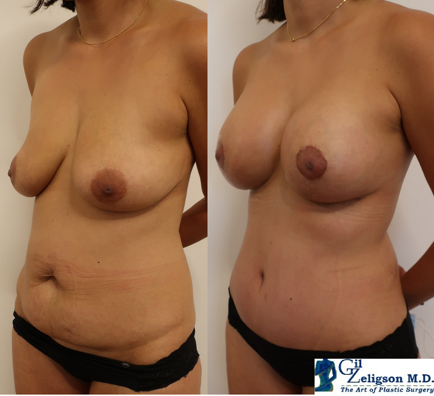 Dr. Gil Zeligson - Mastopexy + Augmentation