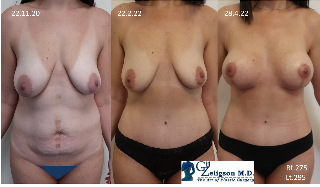 Dr. Gil Zeligson - Mastopexy + Augmentation
