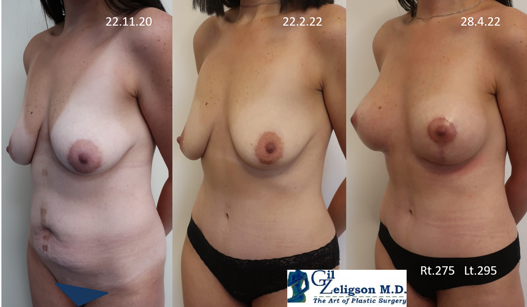 Dr. Gil Zeligson - Mastopexy + Augmentation