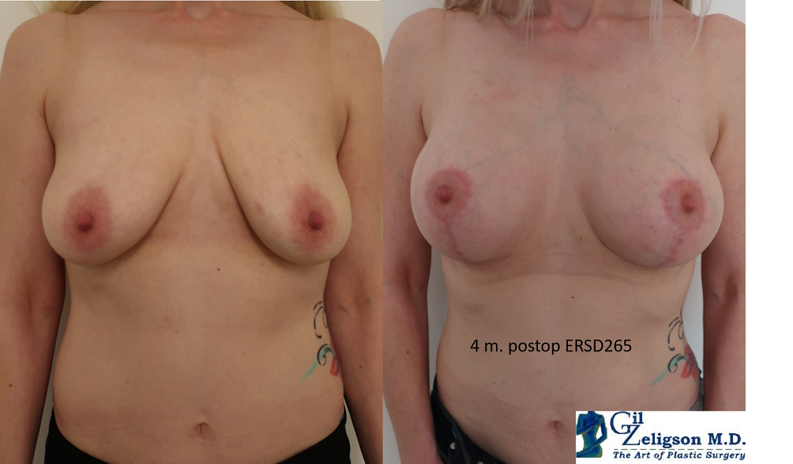 Dr. Gil Zeligson - Mastopexy + Augmentation