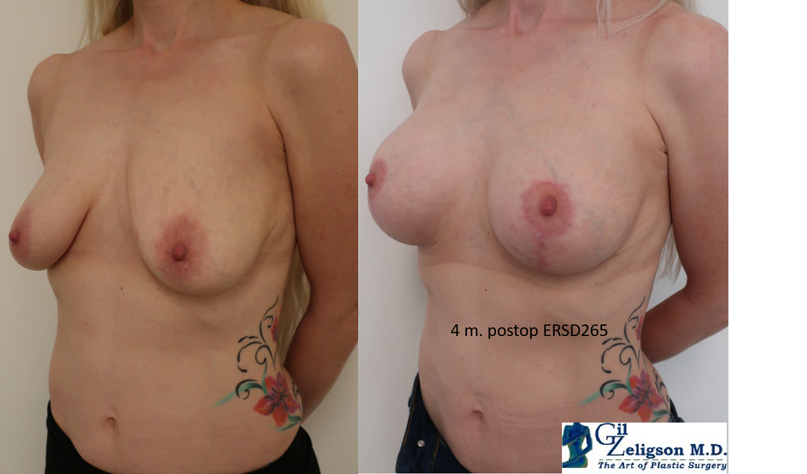 Dr. Gil Zeligson - Mastopexy + Augmentation