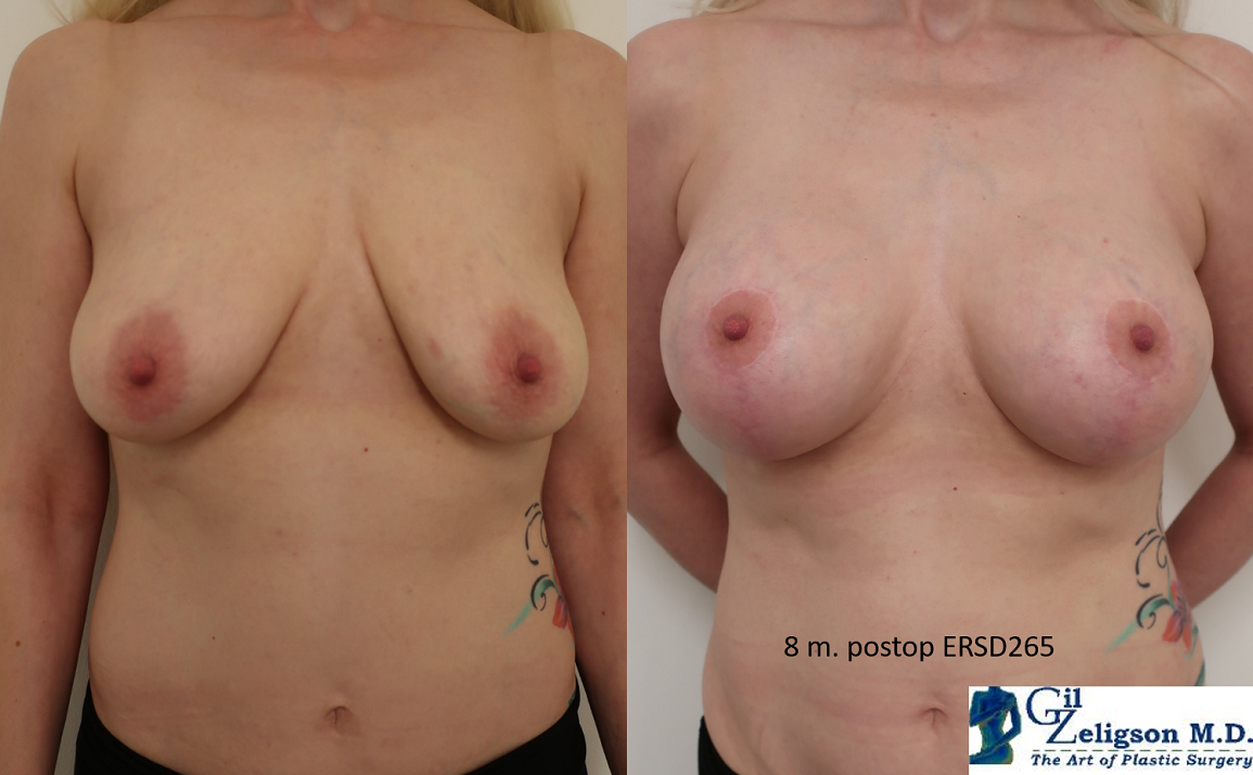 Dr. Gil Zeligson - Mastopexy + Augmentation