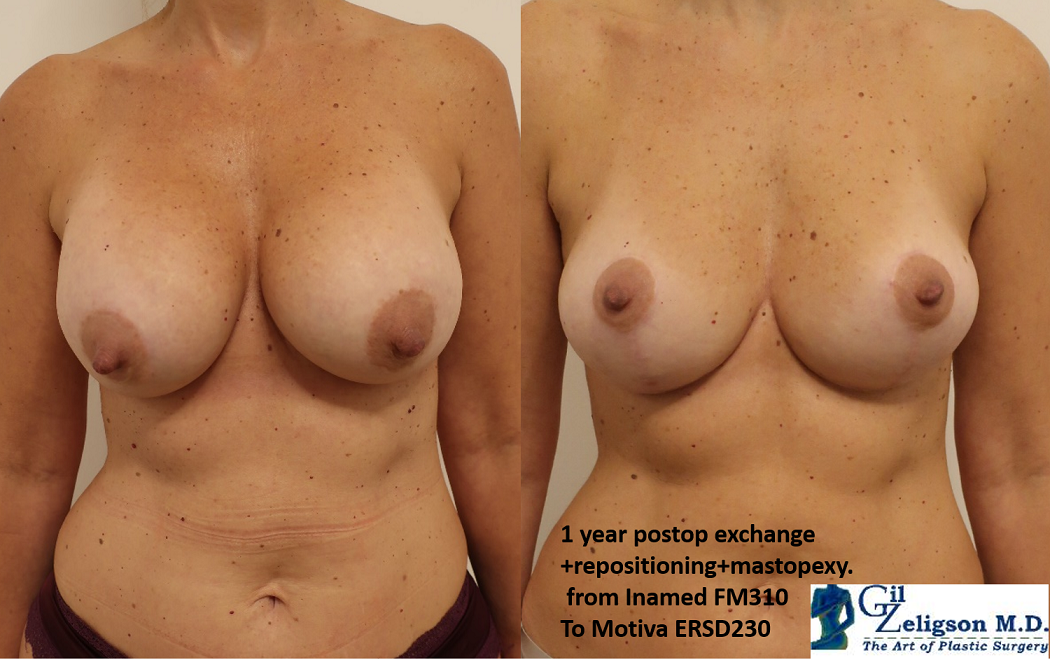 Dr. Gil Zeligson - Mastopexy + Augmentation