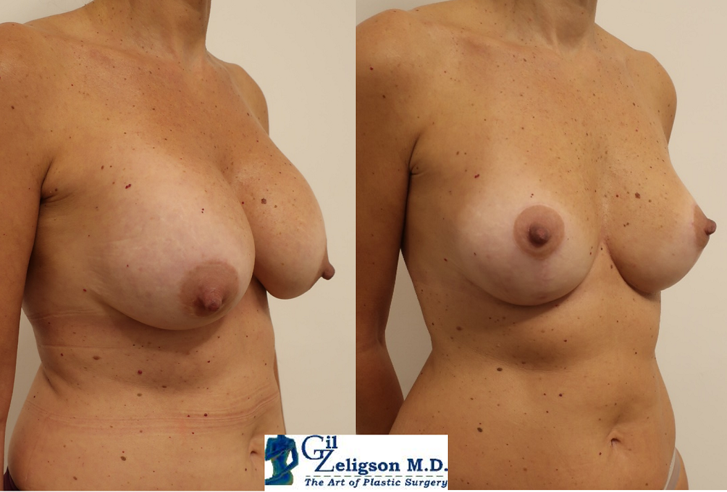 Dr. Gil Zeligson - Mastopexy + Augmentation