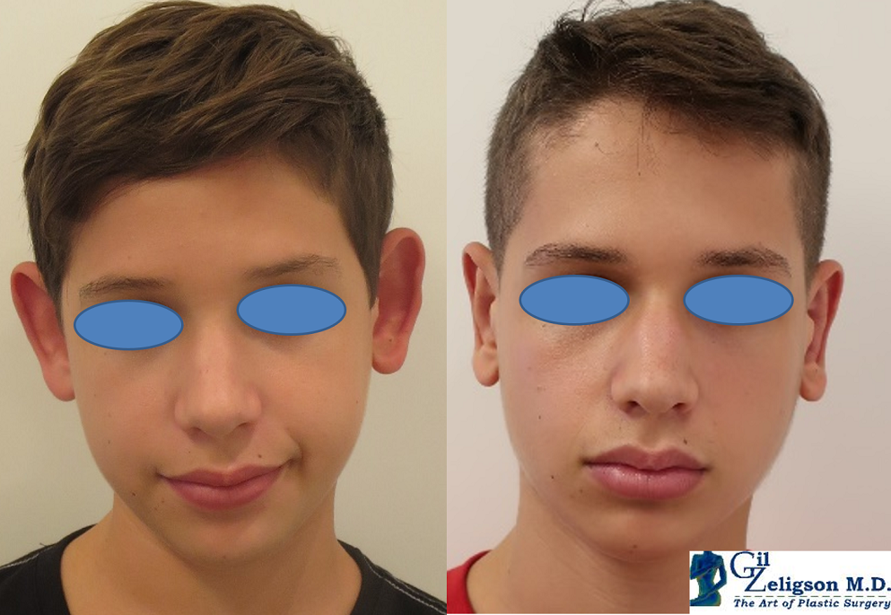  OTOPLASTY - DR. GIL ZELIGSON