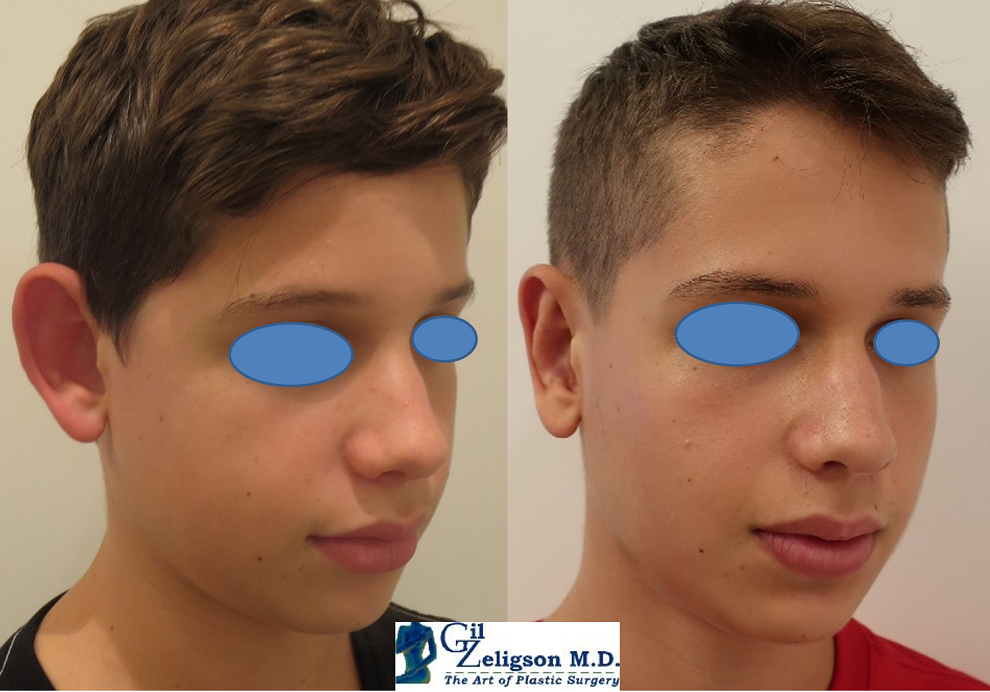  OTOPLASTY - DR. GIL ZELIGSON