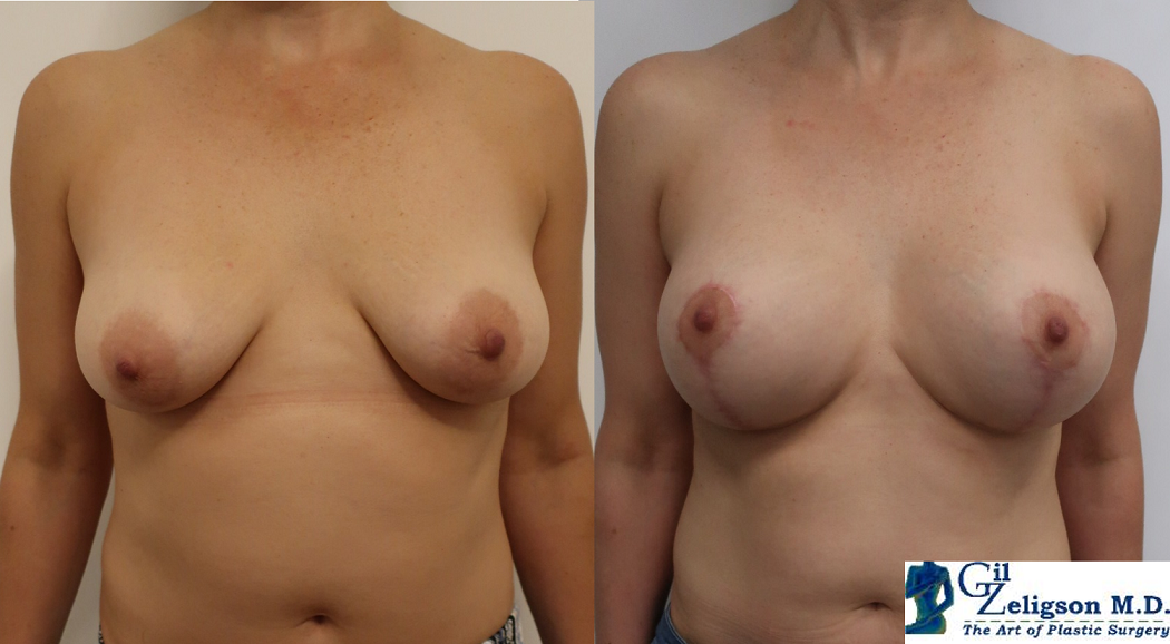 Dr. Gil Zeligson - Mastopexy + Augmentation