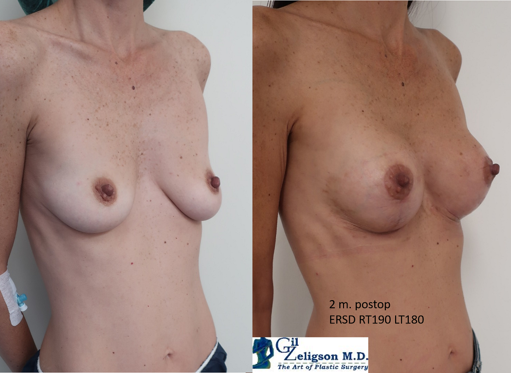 Dr. Gil Zeligson - Mastopexy + Augmentation