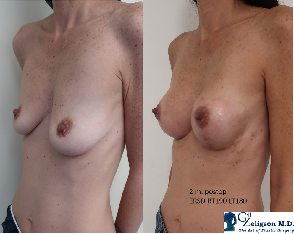 Dr. Gil Zeligson - Mastopexy + Augmentation