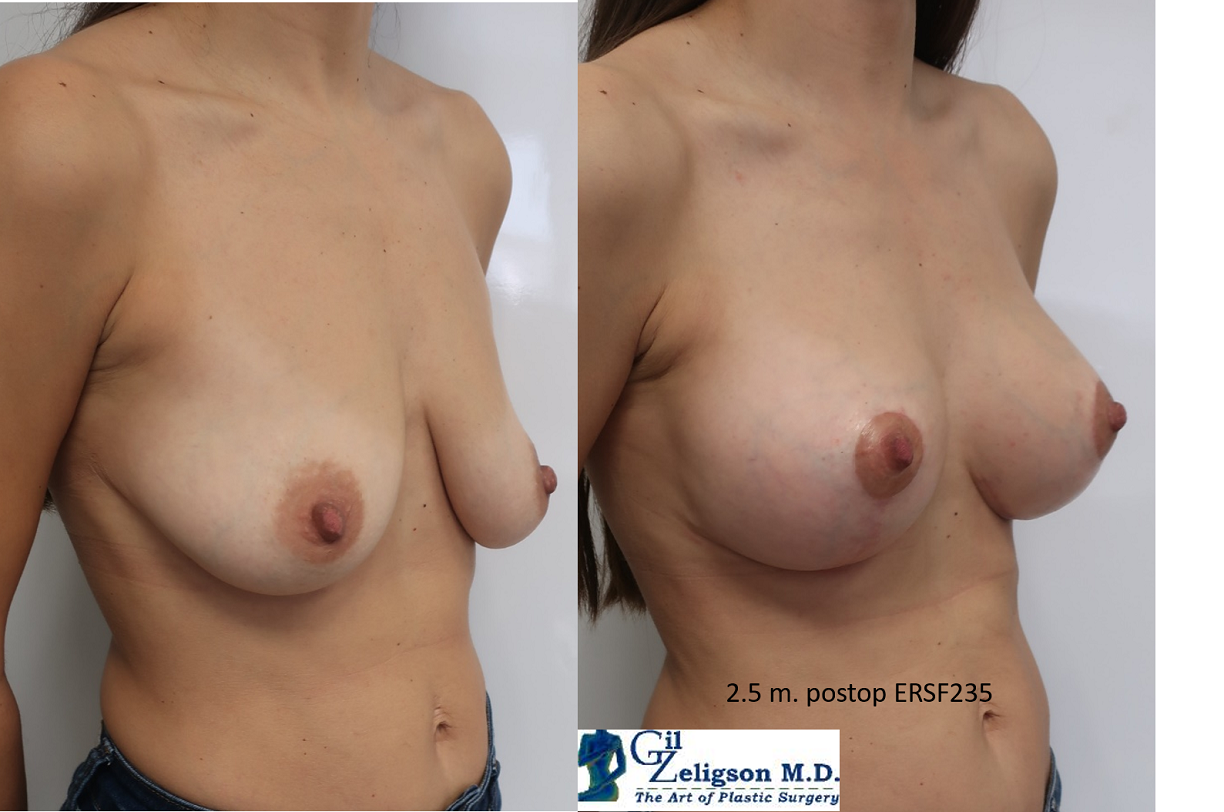 Dr. Gil Zeligson - Mastopexy + Augmentation