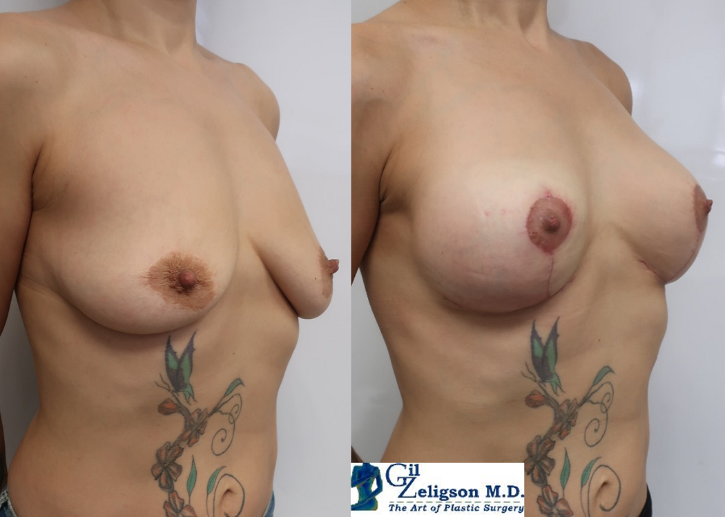 Dr. Gil Zeligson - Mastopexy + Augmentation