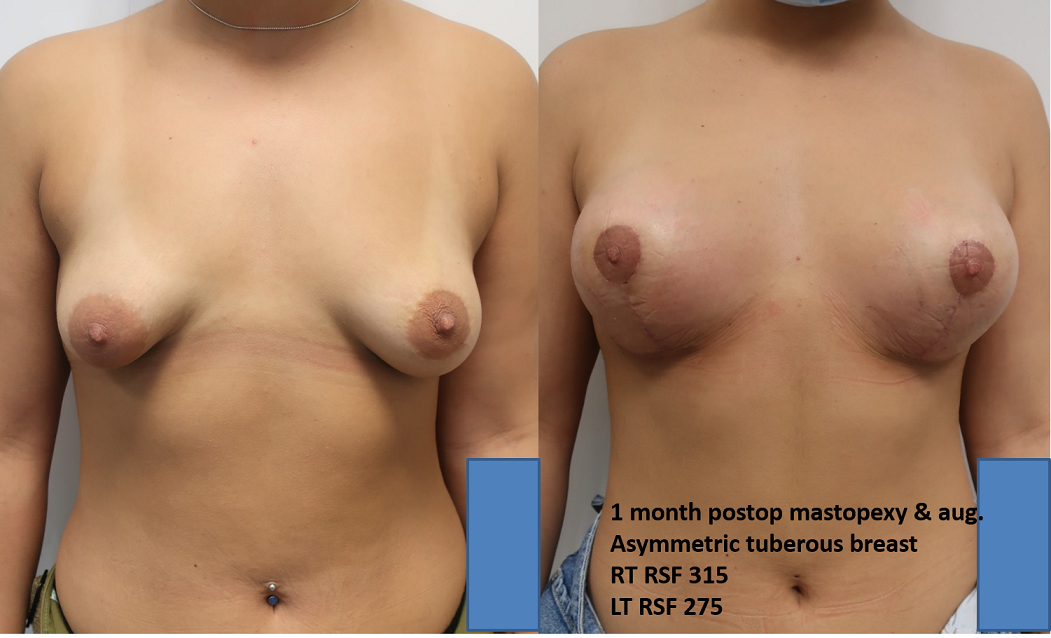 Dr. Gil Zeligson - Mastopexy + Augmentation