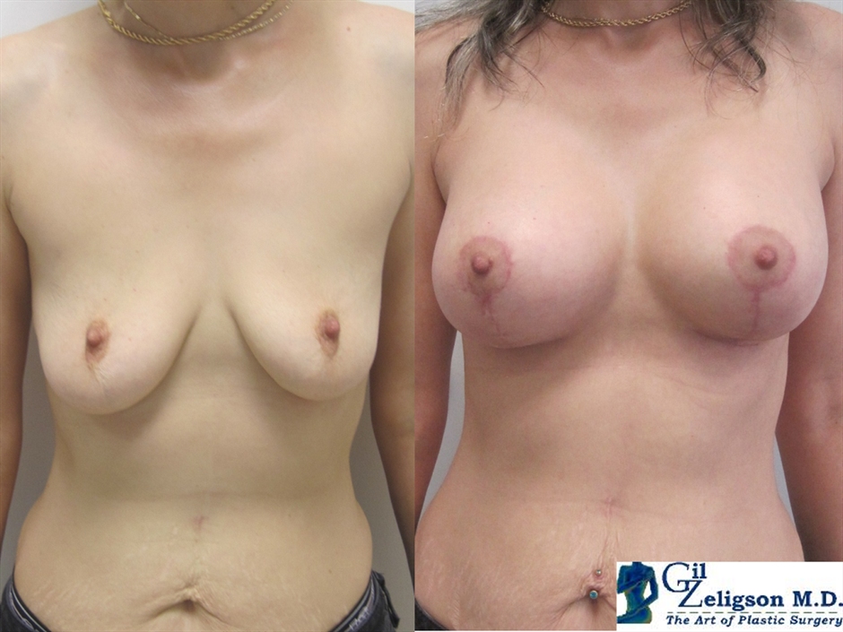 Dr. Gil Zeligson - Mastopexy + Augmentation
