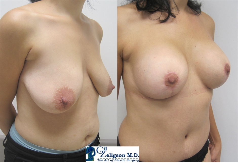 Dr. Gil Zeligson - Mastopexy + Augmentation