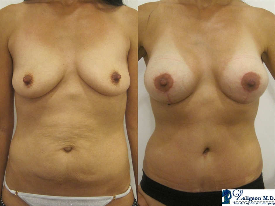 Dr. Gil Zeligson - Mastopexy + Augmentation