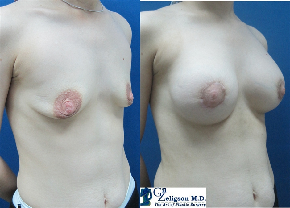 Dr. Gil Zeligson - Mastopexy + Augmentation