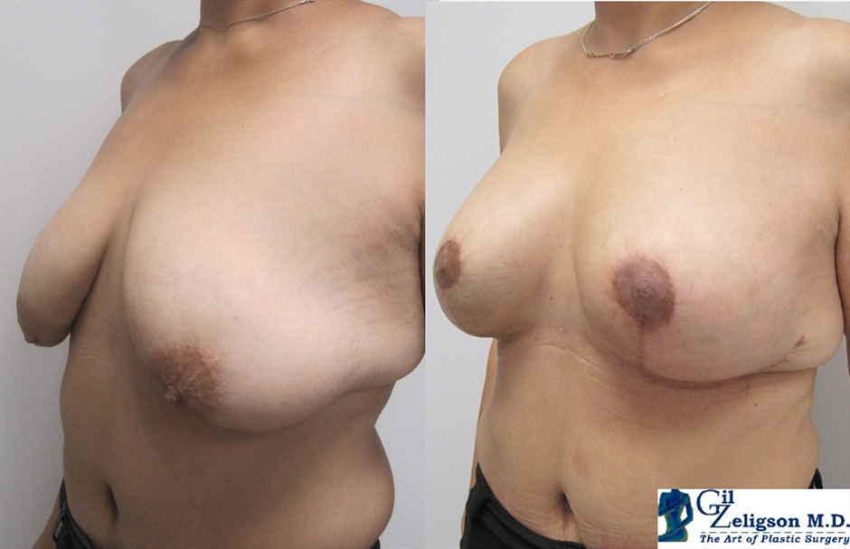 Dr. Gil Zeligson - Mastopexy + Augmentation