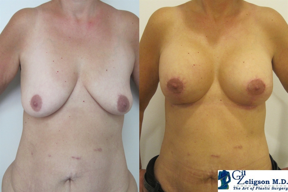 Dr. Gil Zeligson - Mastopexy + Augmentation