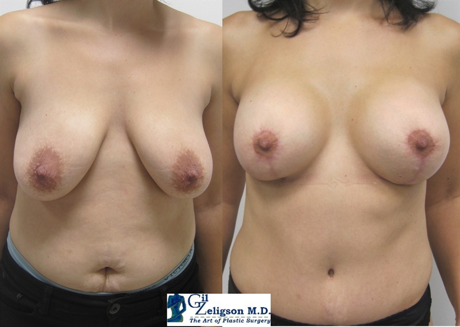 Dr. Gil Zeligson - Mastopexy + Augmentation