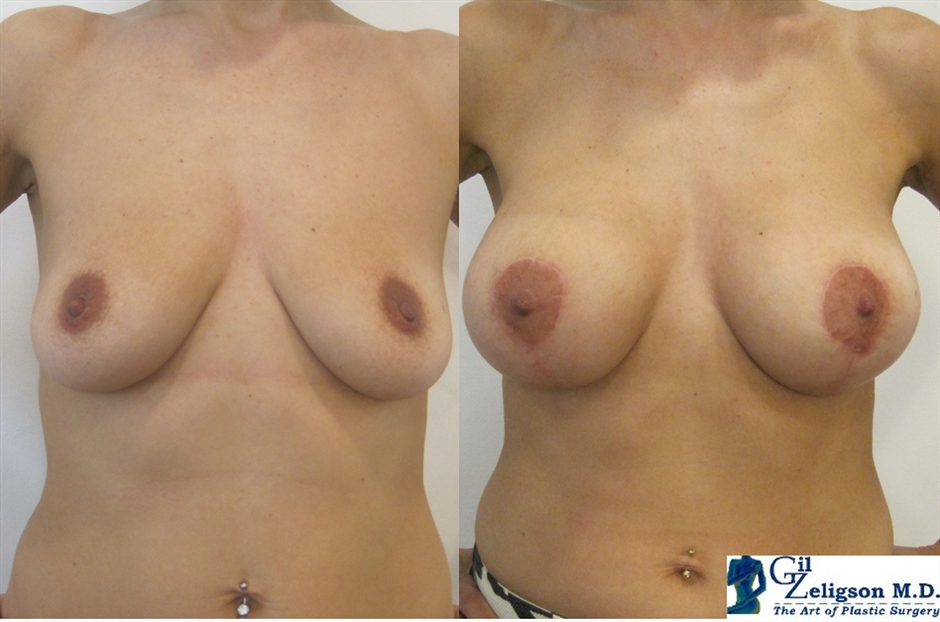 Dr. Gil Zeligson - Mastopexy + Augmentation