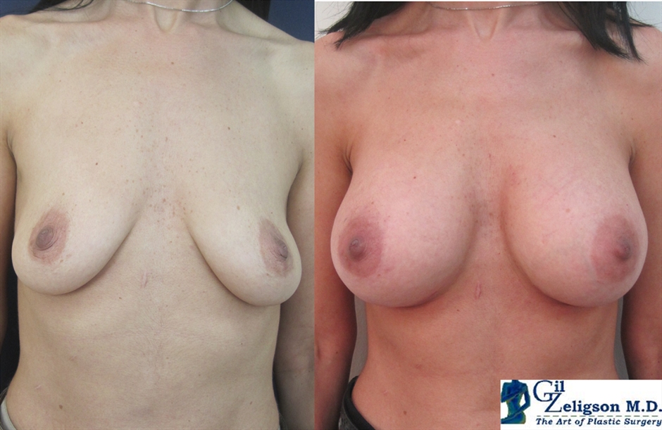 Dr. Gil Zeligson - Mastopexy + Augmentation
