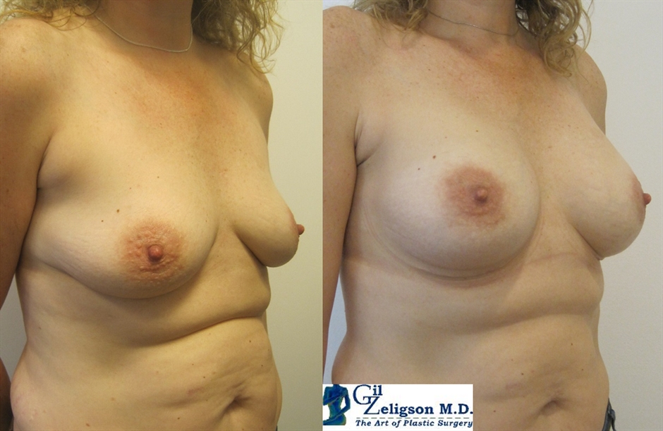 Dr. Gil Zeligson - Mastopexy + Augmentation