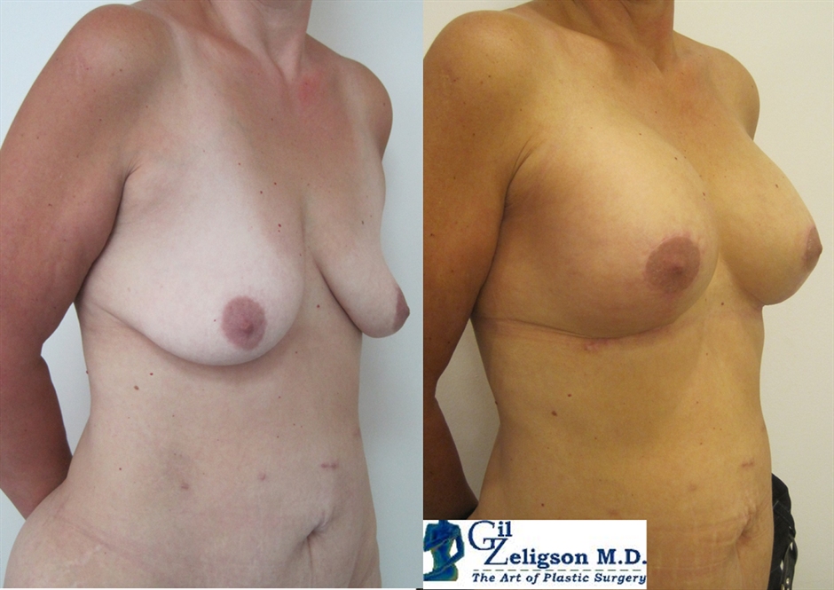 Dr. Gil Zeligson - Mastopexy + Augmentation