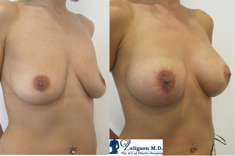 Dr. Gil Zeligson - Mastopexy + Augmentation