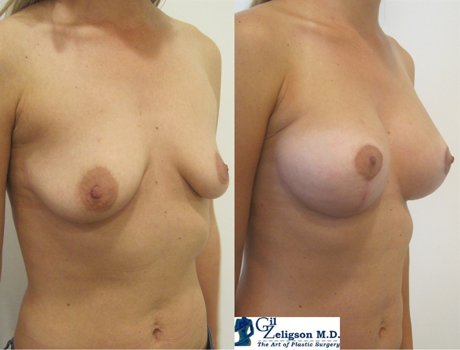 Dr. Gil Zeligson - Mastopexy + Augmentation