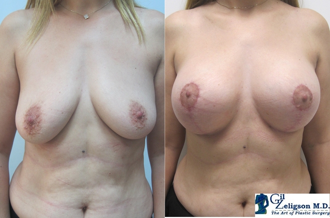 Dr. Gil Zeligson - Mastopexy + Augmentation