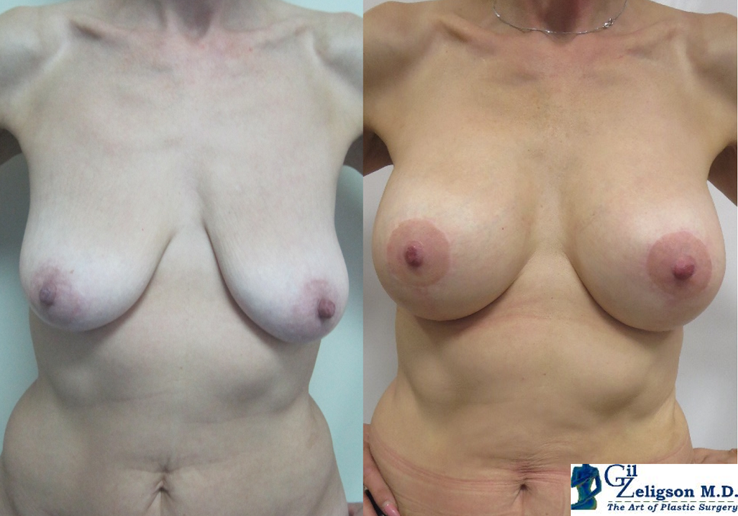 Dr. Gil Zeligson - Mastopexy + Augmentation