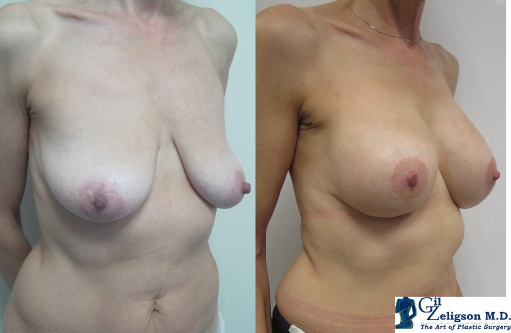 Dr. Gil Zeligson - Mastopexy + Augmentation