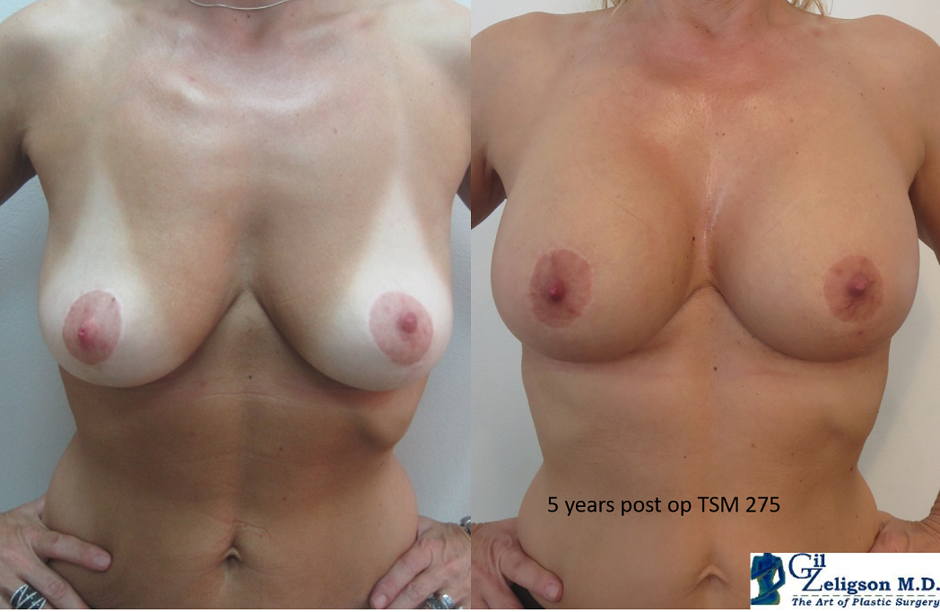 Dr. Gil Zeligson - Mastopexy + Augmentation