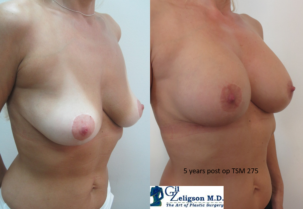 Dr. Gil Zeligson - Mastopexy + Augmentation