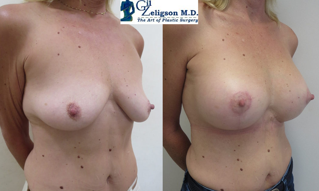 Dr. Gil Zeligson - Mastopexy + Augmentation
