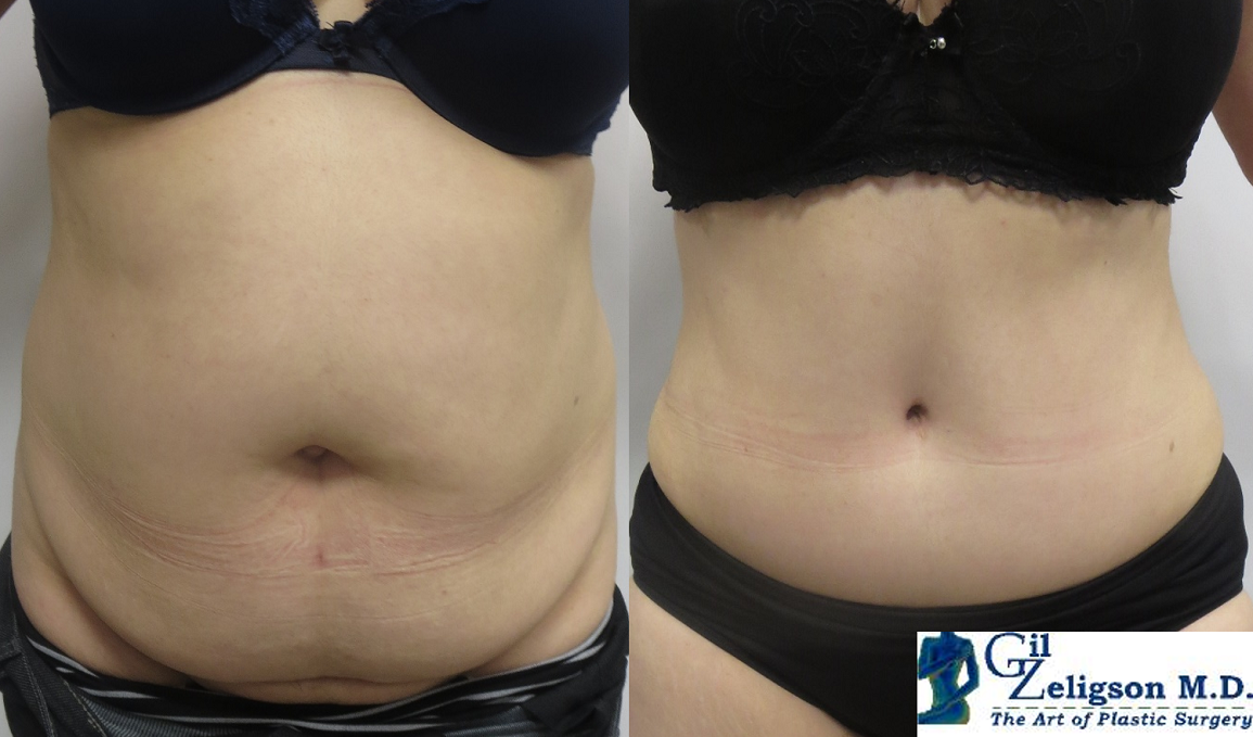 LIPOABDOMINOPLASTY - DR. GIL