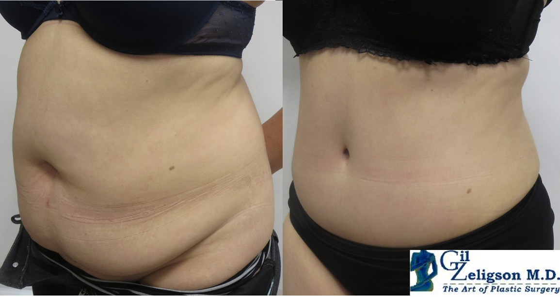 LIPOABDOMINOPLASTY - DR. GIL