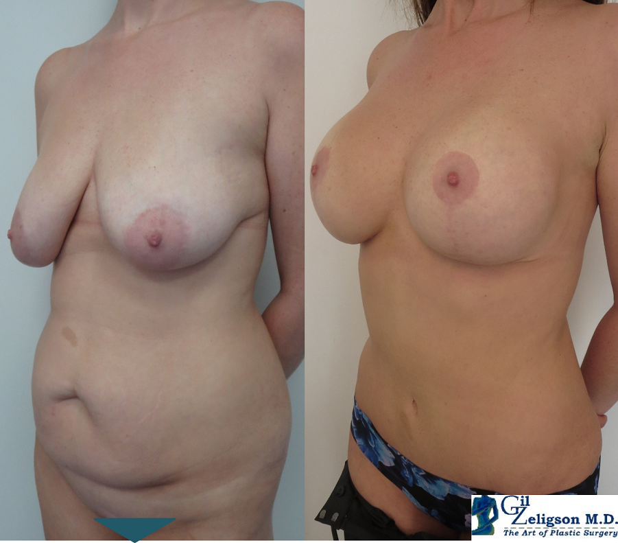 Dr. Gil Zeligson - Mastopexy + Augmentation
